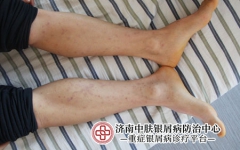 银屑病病程的三个阶段是什么?预防银屑病的方法?
