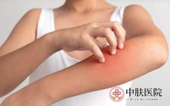 牛皮癣的发病原因是什么 牛皮癣的注意事项有哪些呢