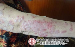 近期银屑病关节炎好治吗？专家详解：实用秘诀分享