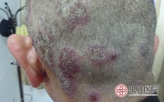 脓疱型银屑病晚期症状及科学应对指南