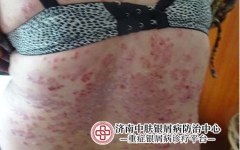 近期银屑病用什么药好得快？专家详解：这6类种最常用