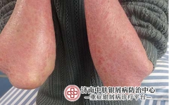 银屑病掉皮后如何护理？恢复皮肤健康指南