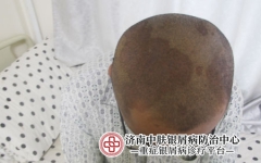 牛皮癣的五个常见病因有哪些?