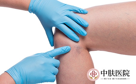 摄图网_303522806_医生亲手检查女腿和紧闭的容器上变血管（企业商用）